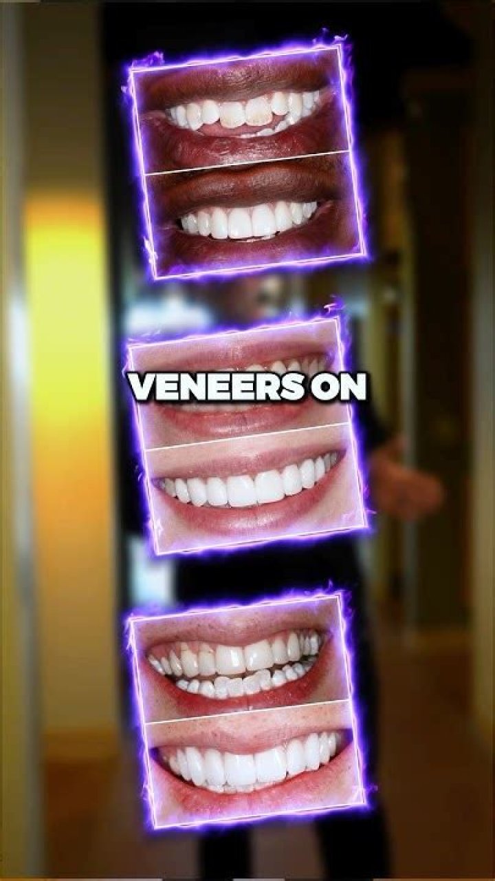 Do veneers look weird?