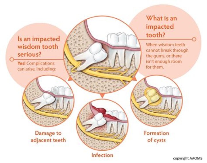 Do wisdom teeth hurt?