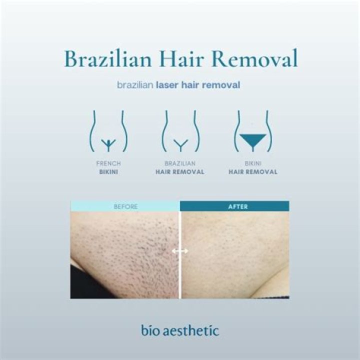 Does a Brazilian laser include bum crack?