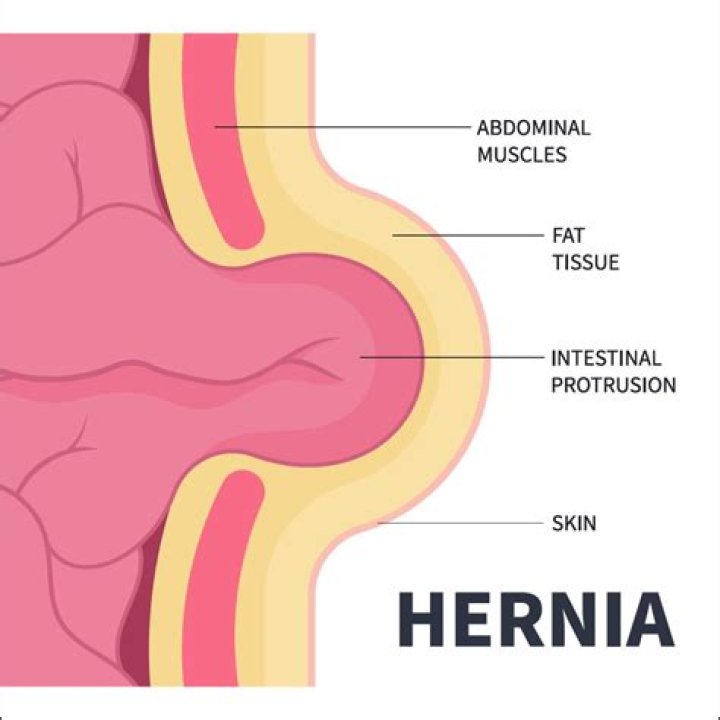Does a hernia make you look fat?