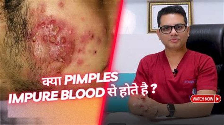 Does a pimple have a core?