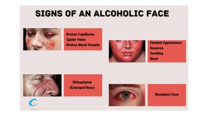 Does alcohol make your face droop?