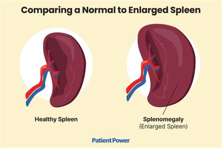 Does an enlarged spleen cause bloating?