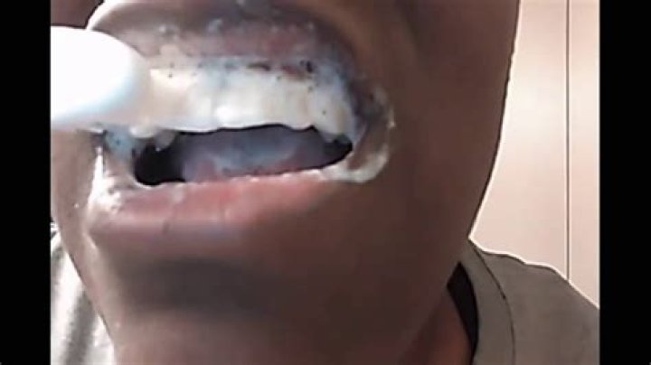 Does baking soda damage teeth?