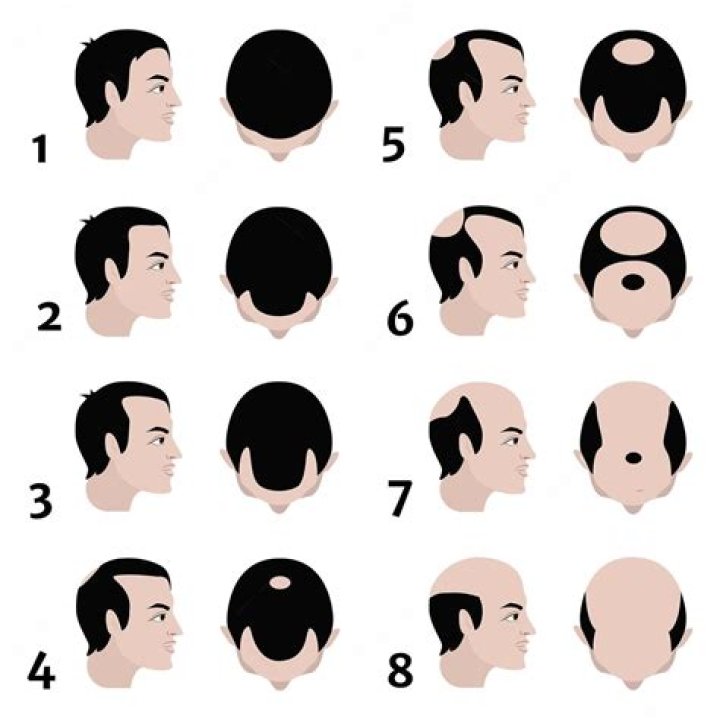 Does balding affect dating?
