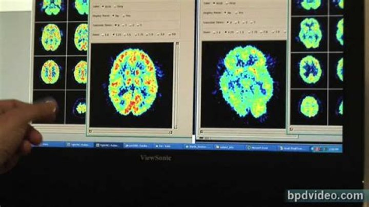 Does BPD show up on a brain scan?
