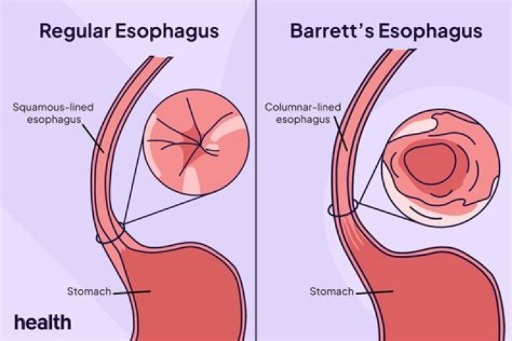 Does COVID affect Barrett esophagus?