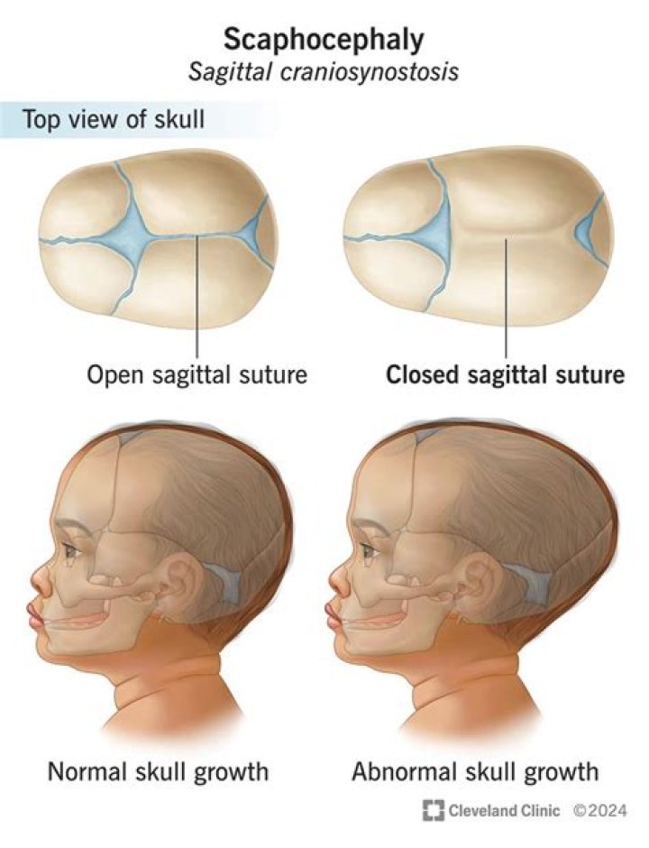 Does craniosynostosis always need surgery?