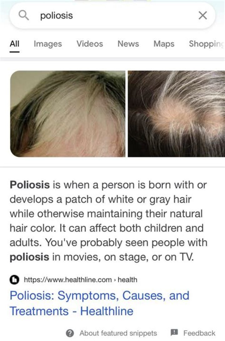 Does Cruella have Poliosis?