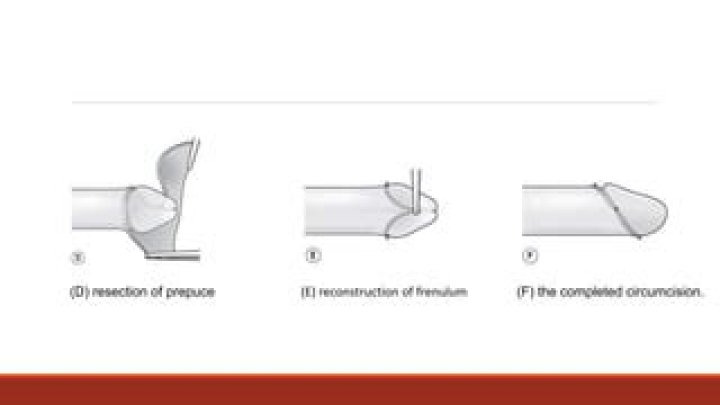 Does cut frenulum increase size?