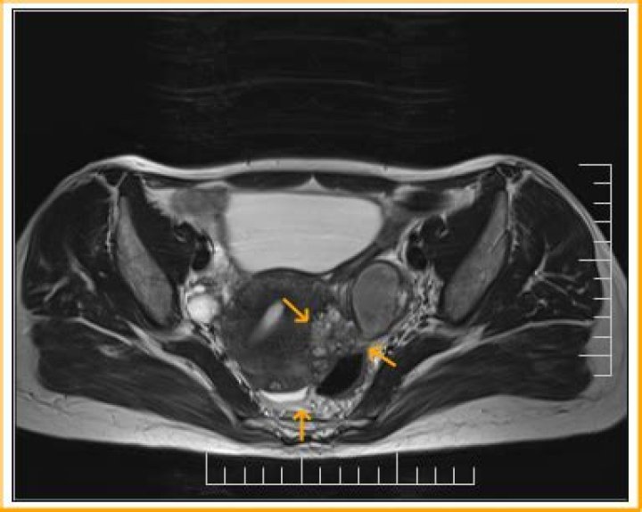 Does endometriosis show on MRI?