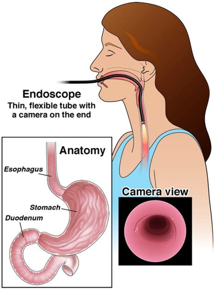 Does endoscopy show stomach cancer?
