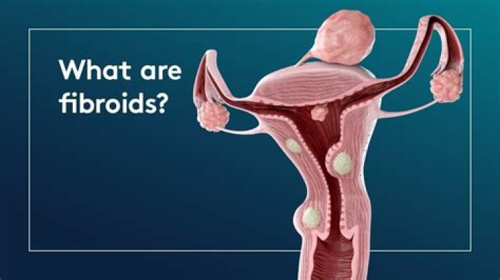 Does every woman have fibroid?