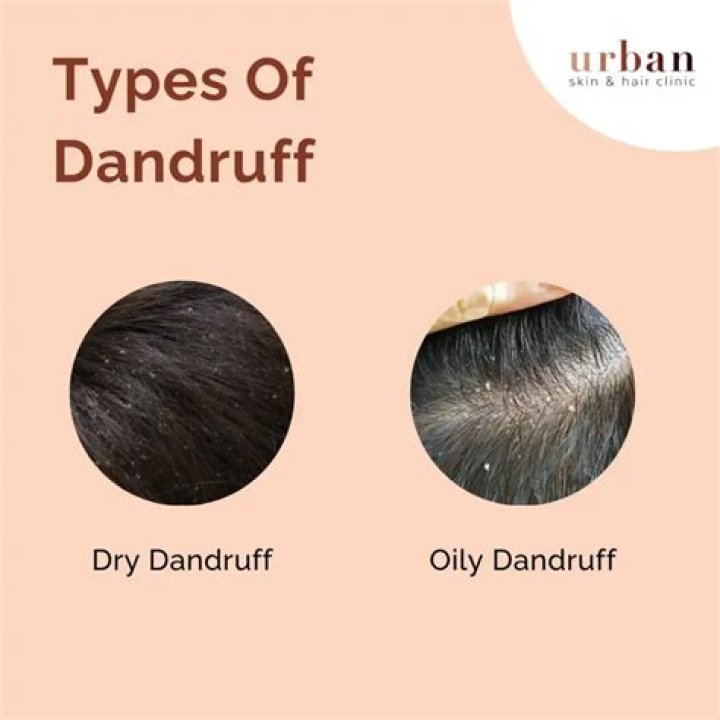 Does everyone have dandruff?