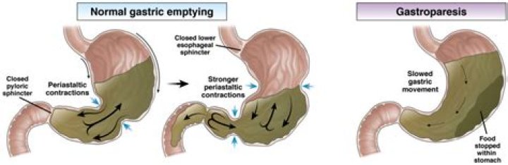 Does gastroparesis get worse with time?
