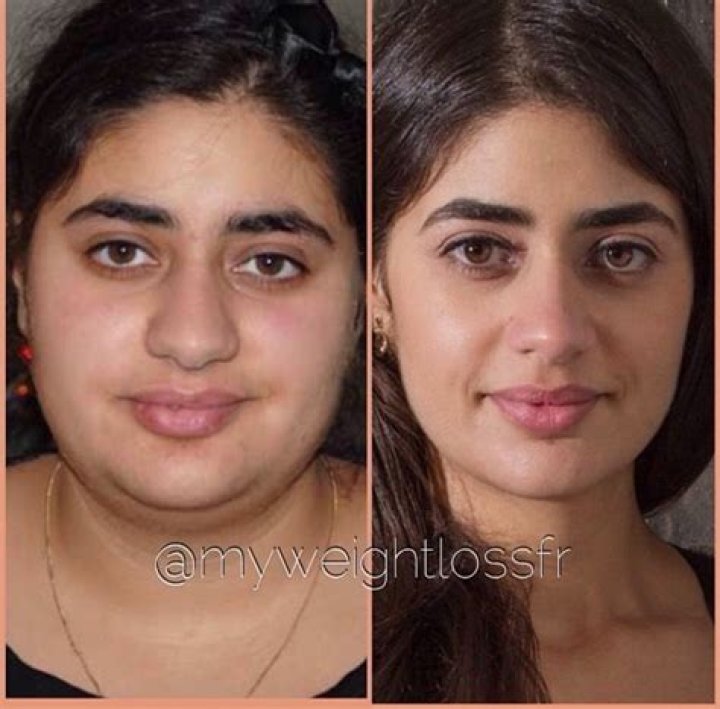 Does losing face fat make your nose smaller?