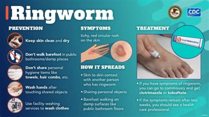 Does lotion make ringworm worse?