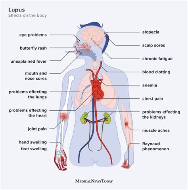 Does lupus make you moody?