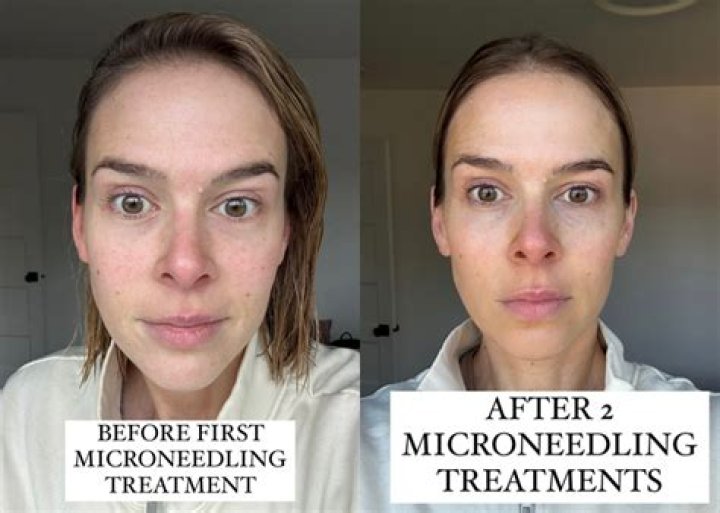 Does Microneedling help white scars?