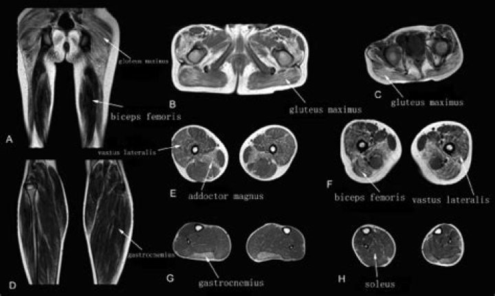 Does MRI show muscle inflammation?