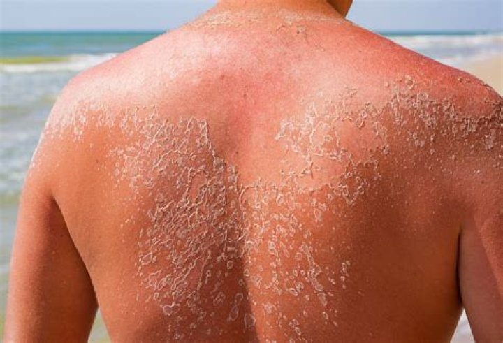 Does peeling sunburn scar?