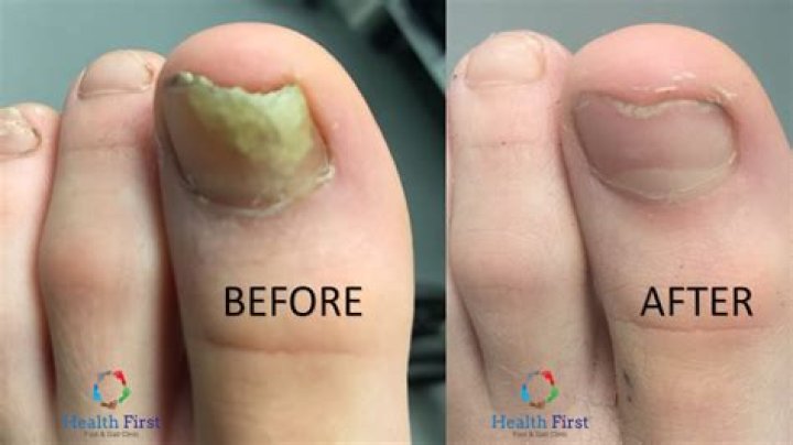 Does RA affect your toenails?