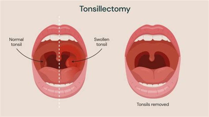 Does removing tonsils stop tonsil stones?