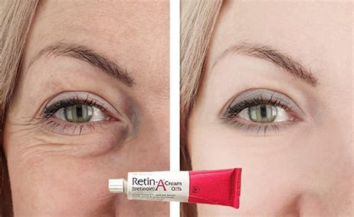 Does Retin-A reduce deep wrinkles?