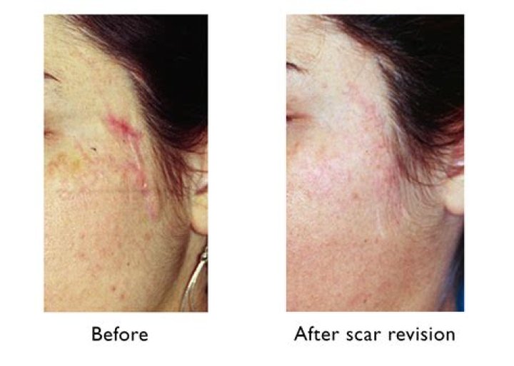 Does scar tissue get worse over time?