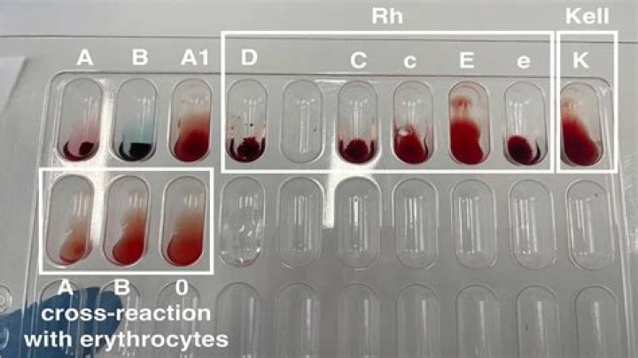 Does Sjogren's always show up in blood test?