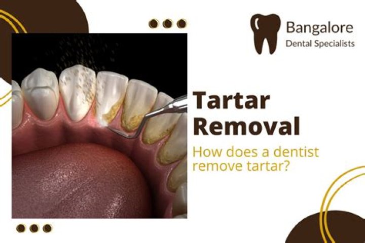 Does tartar removal leave gaps?