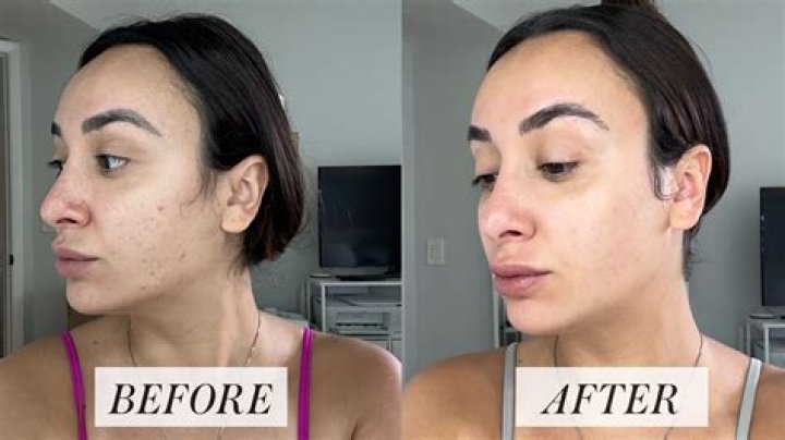 Does vitamin C help with neck wrinkles?