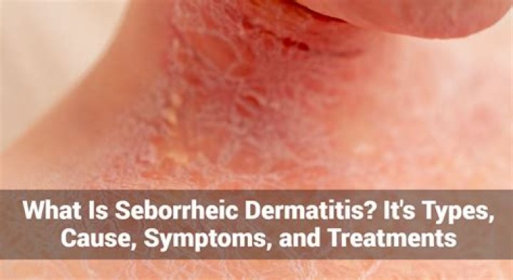 Does Vitamin D Help seborrheic dermatitis?