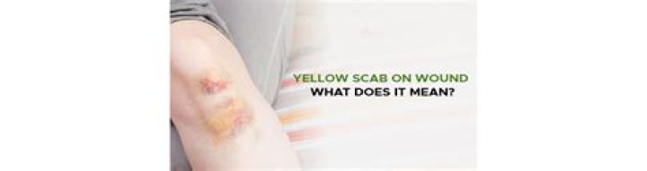 Does yellow in a wound mean infection?