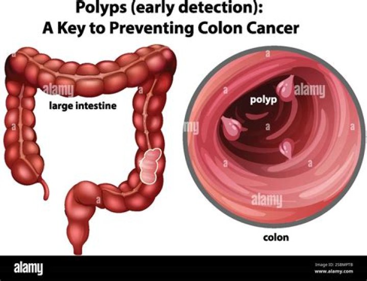 How big is a 20 mm polyp?