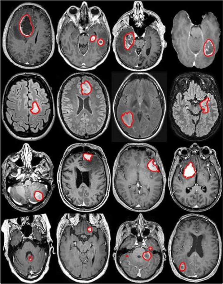 How big is a 3 cm tumor?