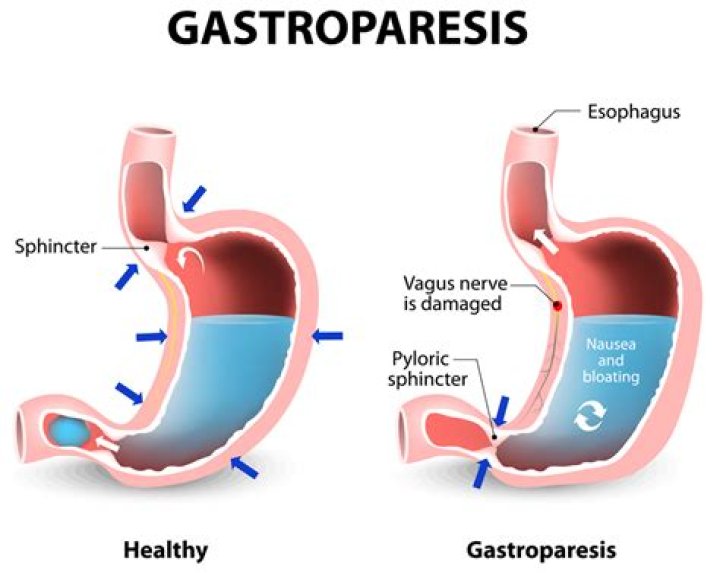How can I cure my gastroparesis?