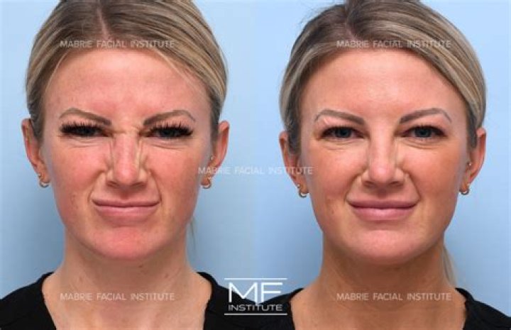 How can I get rid of wrinkles on my face fast?