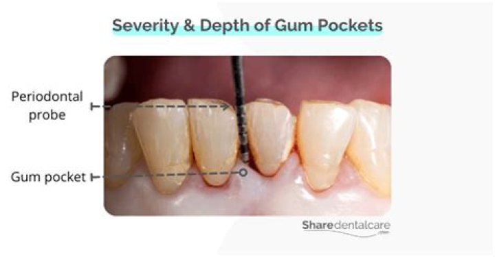 How can I reduce my gum pockets?