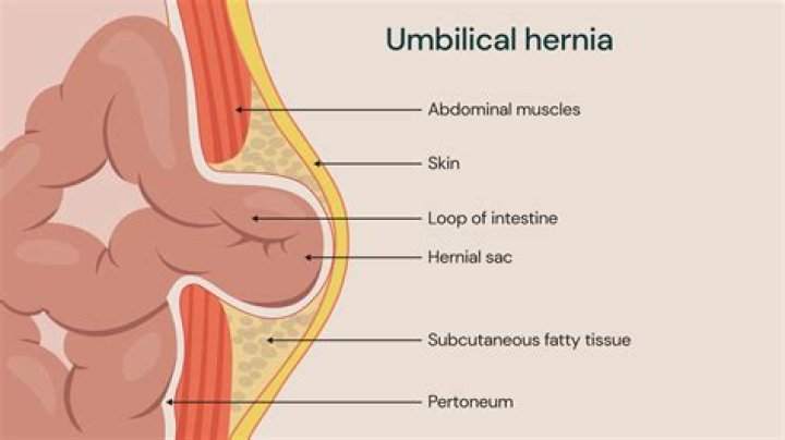 How can I shrink my hernia naturally?