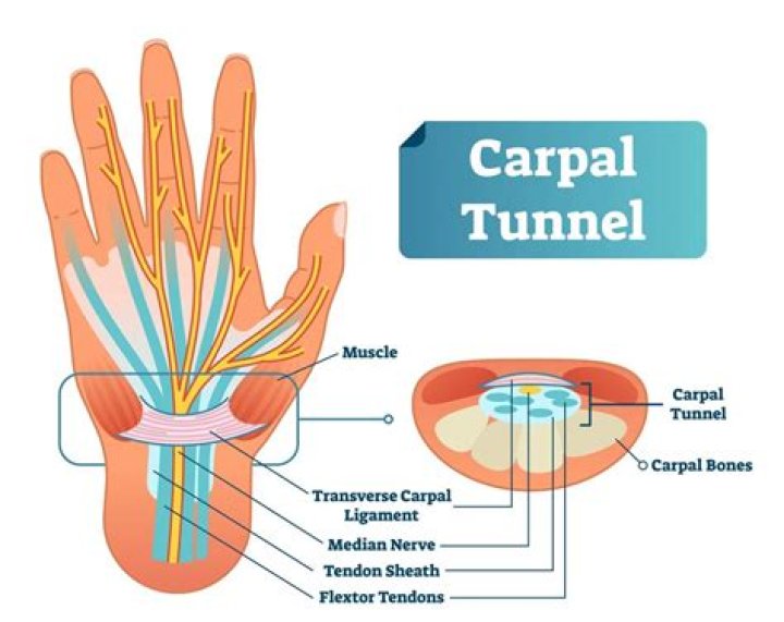 How carpal tunnel affects your life?