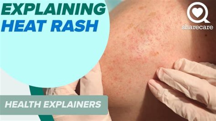 How do I deal with heat rash?