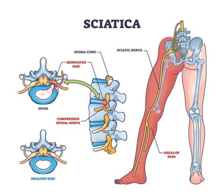 How do I get my sciatica back in place?
