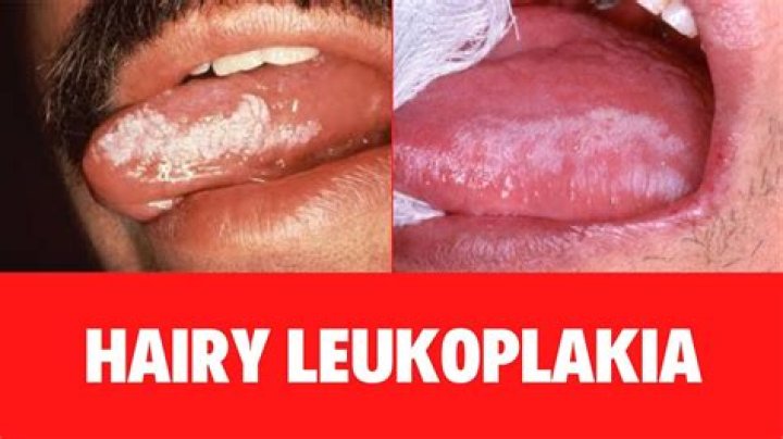 How do I know if I have leukoplakia hairy?