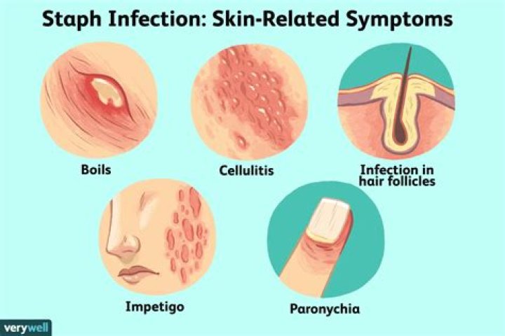 How do I know if I have MRSA or a pimple?