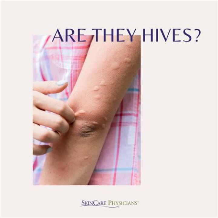 How do I stop hives from itching at night?