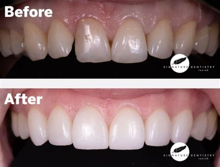 How do I stop my veneers from staining?