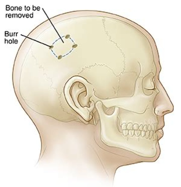 How do they cut the skull for brain surgery?