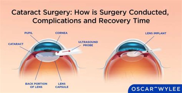 How do they remove cataracts without surgery?