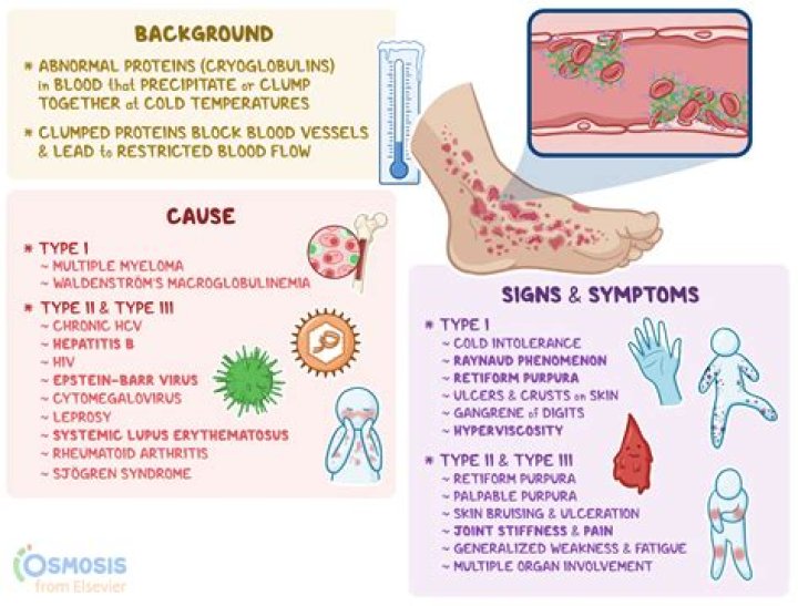 How do you beat Sjogren's fatigue?